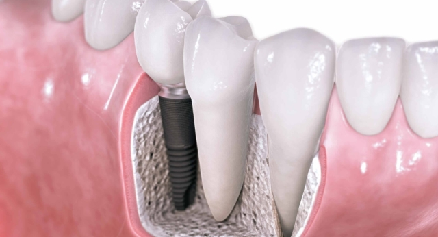 Dental Implants 950x514