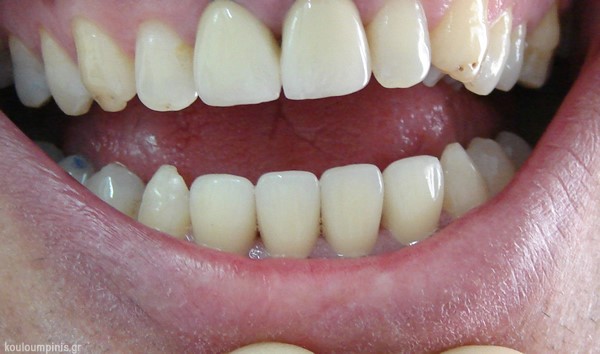 prosthetiki dontion2